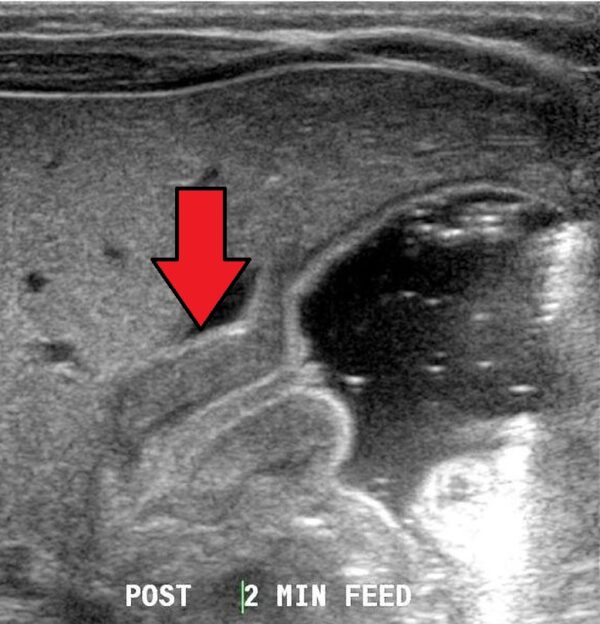 Abdominal ultrasound demonstrating pyloric stenosis