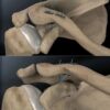 Figure 22. Model showing the use of Ethibond as an anchoring suture during repair of an acromioclavicular joint dislocation.