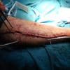 Figure 30. Closure of a lower limb fasciotomy wound with interrupted Prolene sutures