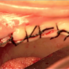 Figure 20. Oral mucosal closure with interrupted silk sutures following maxillary sinus surgery