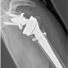 Figure 24. Upper limb X-ray showing cerclage of fracture fragments with steel wire after reverse shoulder arthroplasty for a proximal humerus fracture