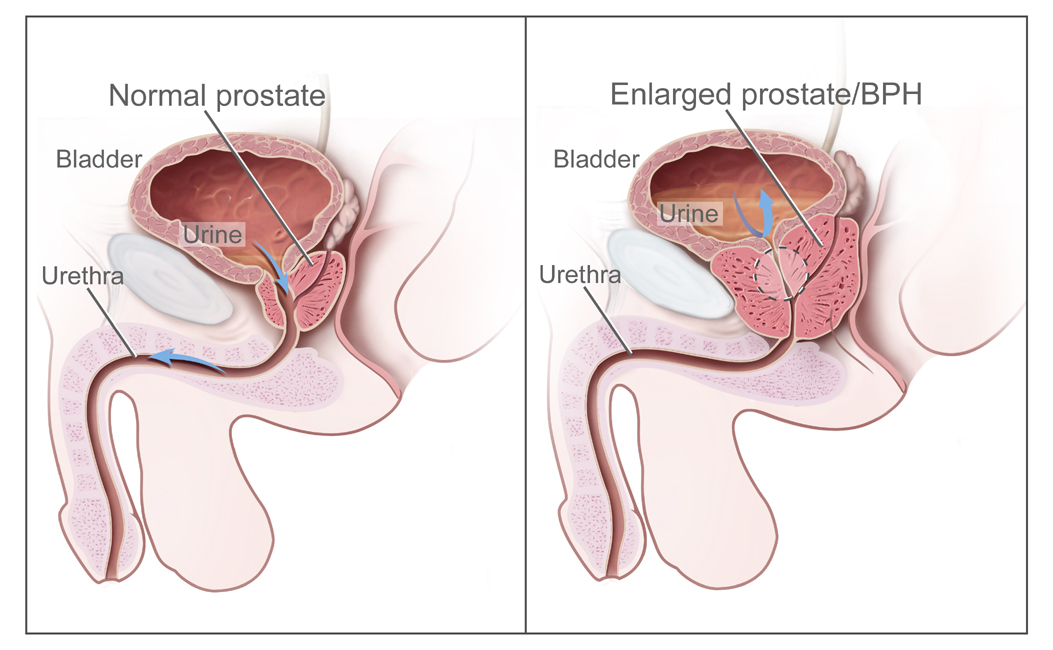 A diagram showing benign prostatic hyperplasia