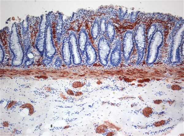 Histopathology of Hirschsprung disease