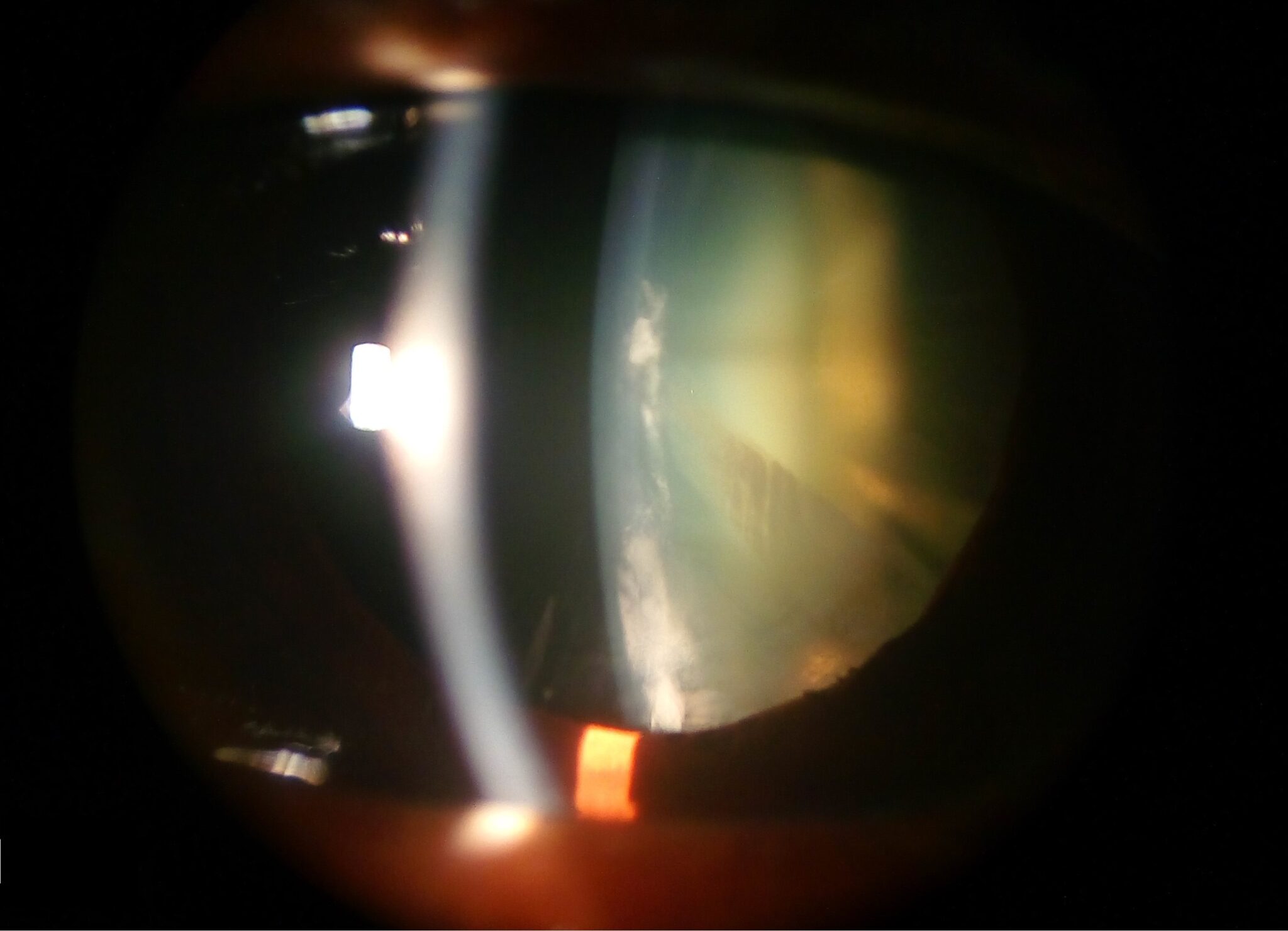 Slit lamp section through a cataract