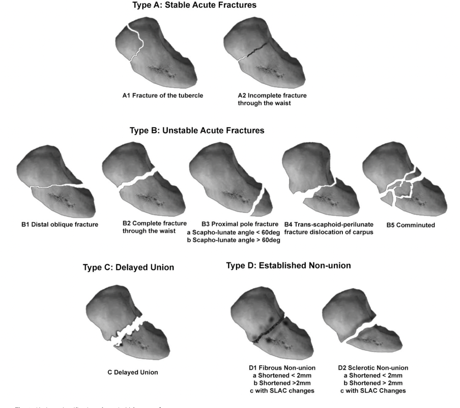 Herbert classification of scaphoid fractures