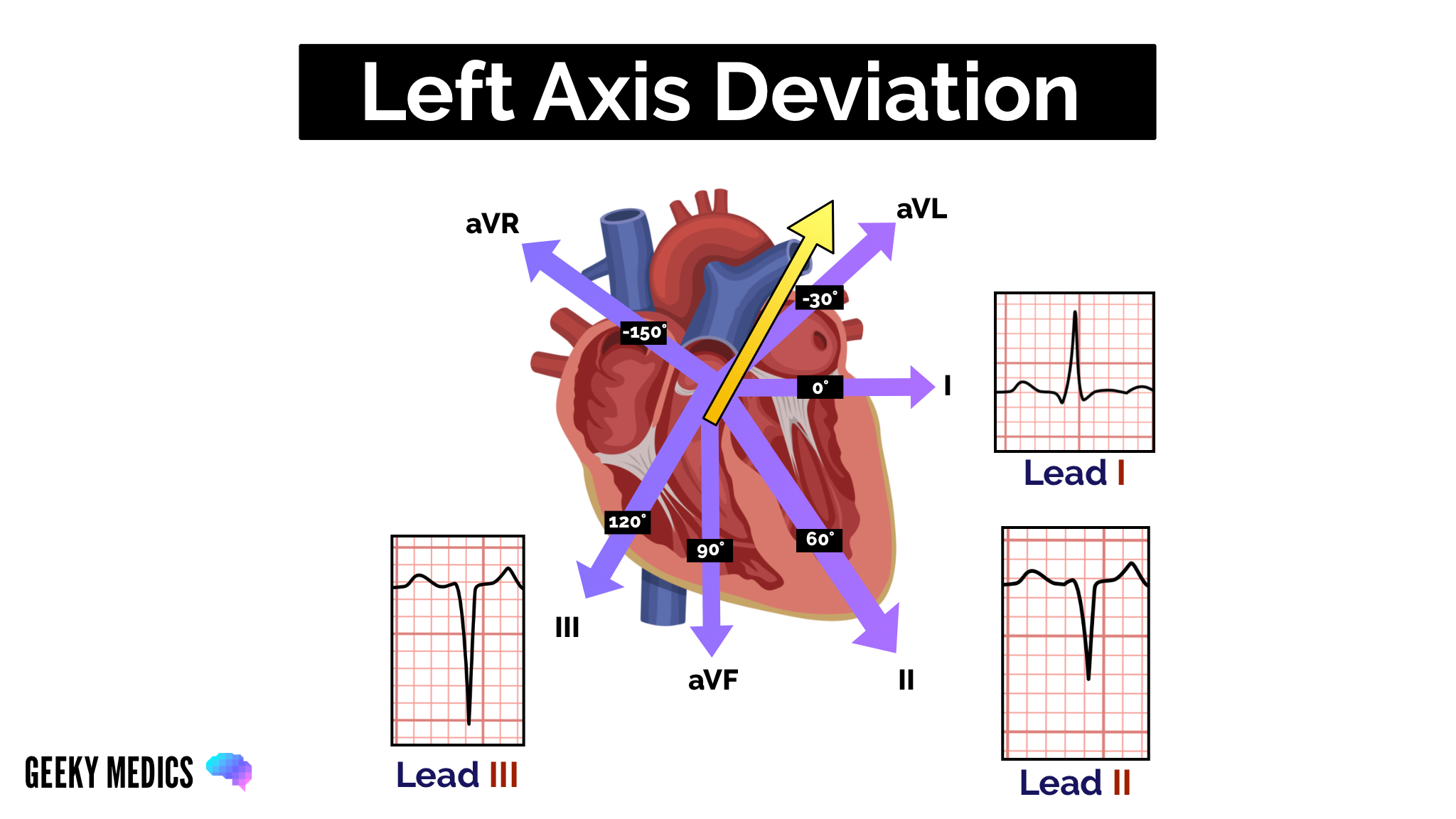 Left Axis Deviation (LAD)