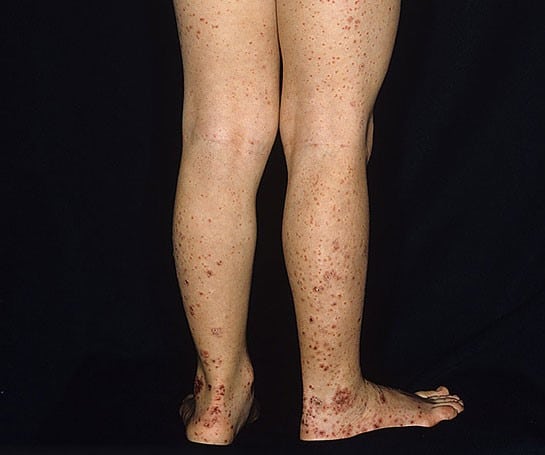Purpuric petechial rash of HSP