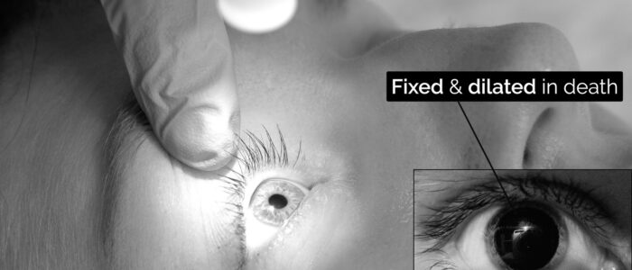 pupil fixed and dilated death