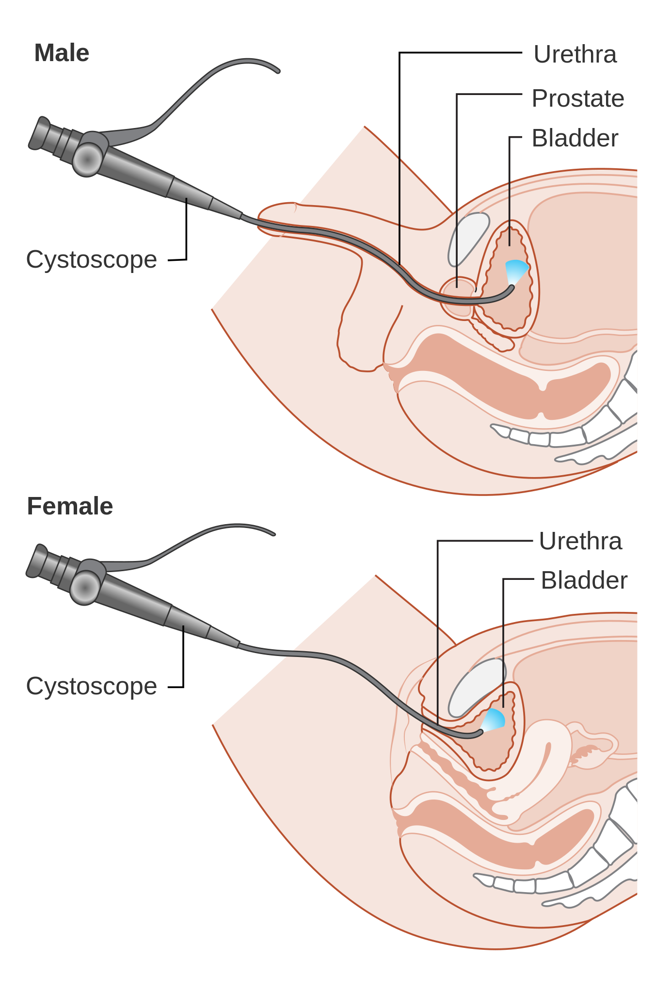 Diagram of a cystoscopy