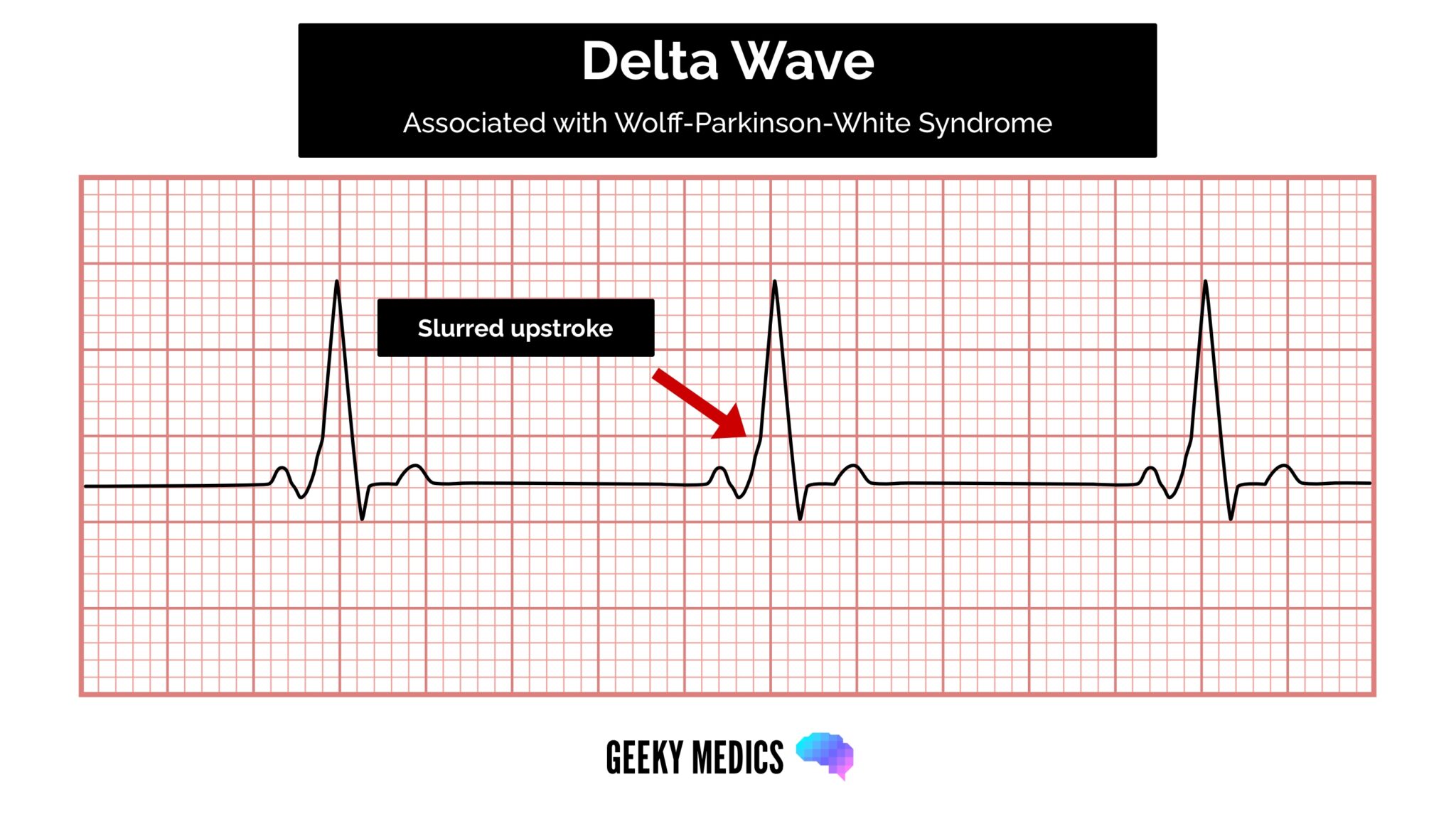 ECG - Delta wave (Wolff Parkinson White Syndrome)