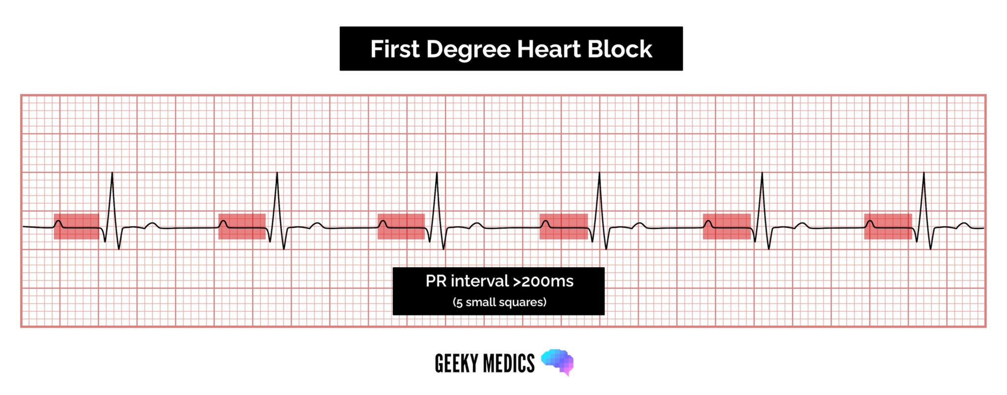 First-degree heart block (AV block)