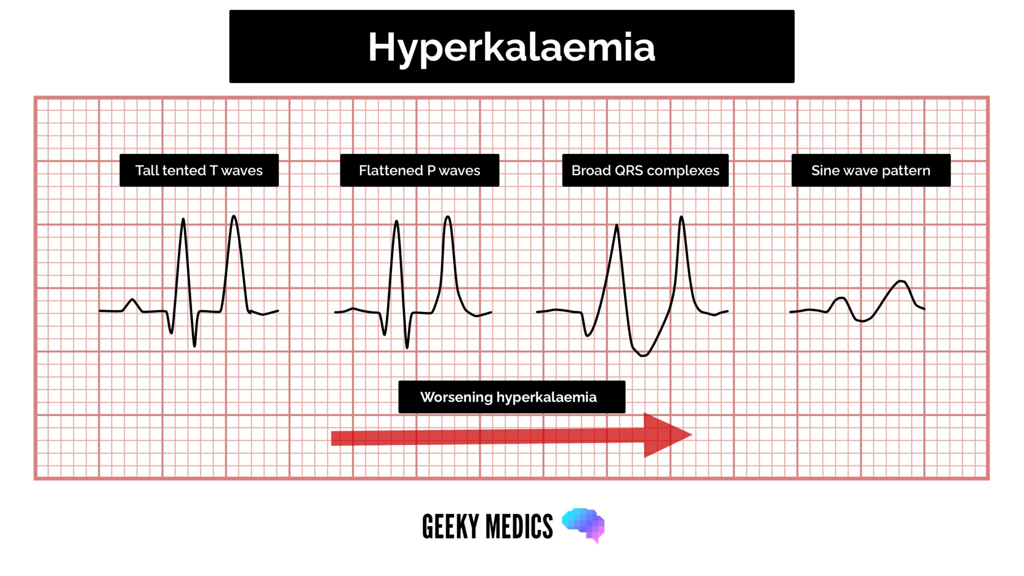 ECG changes in hyperkalaemia