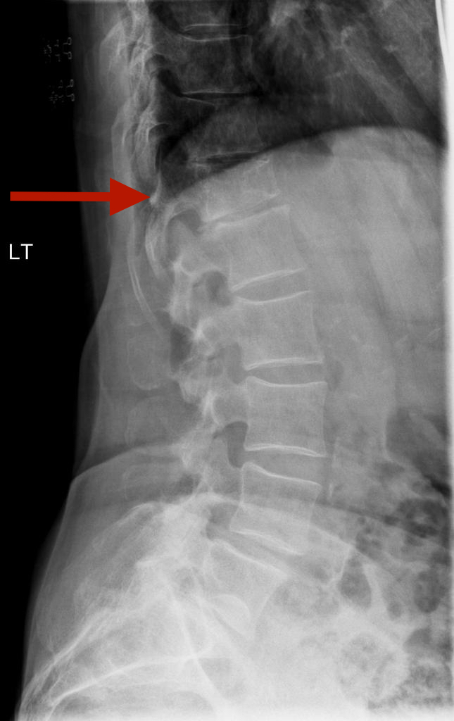 Osteoporotic vertebral wedge fracture