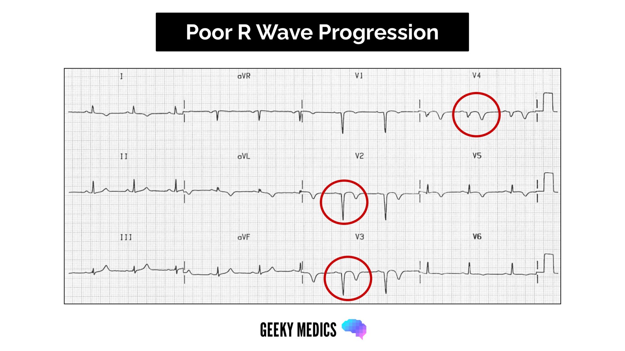 ECG Poor R Wave progression