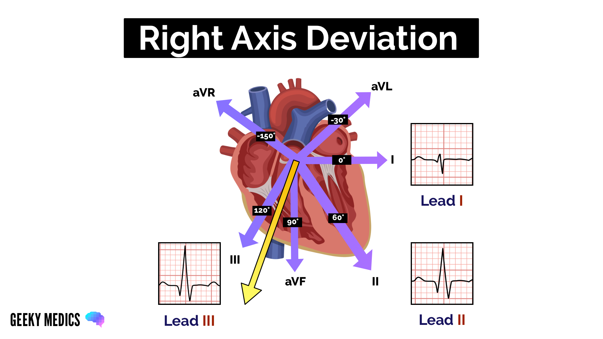 Right Axis Deviation (RAD)