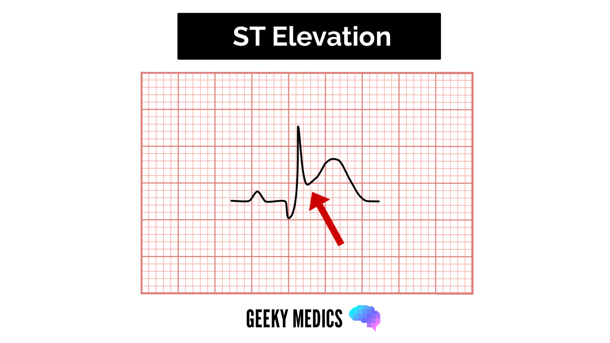 ECG ST Elevation