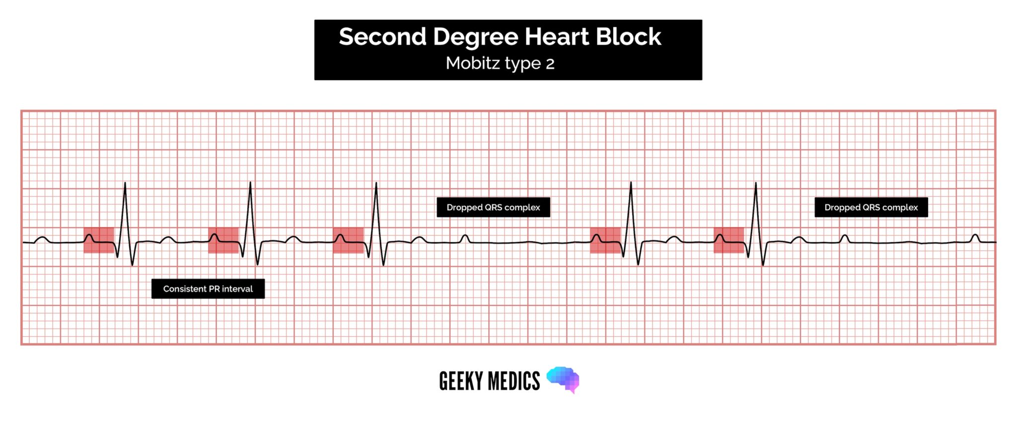 ECG - Second-degree AV block (Mobitz type 2 AV block)