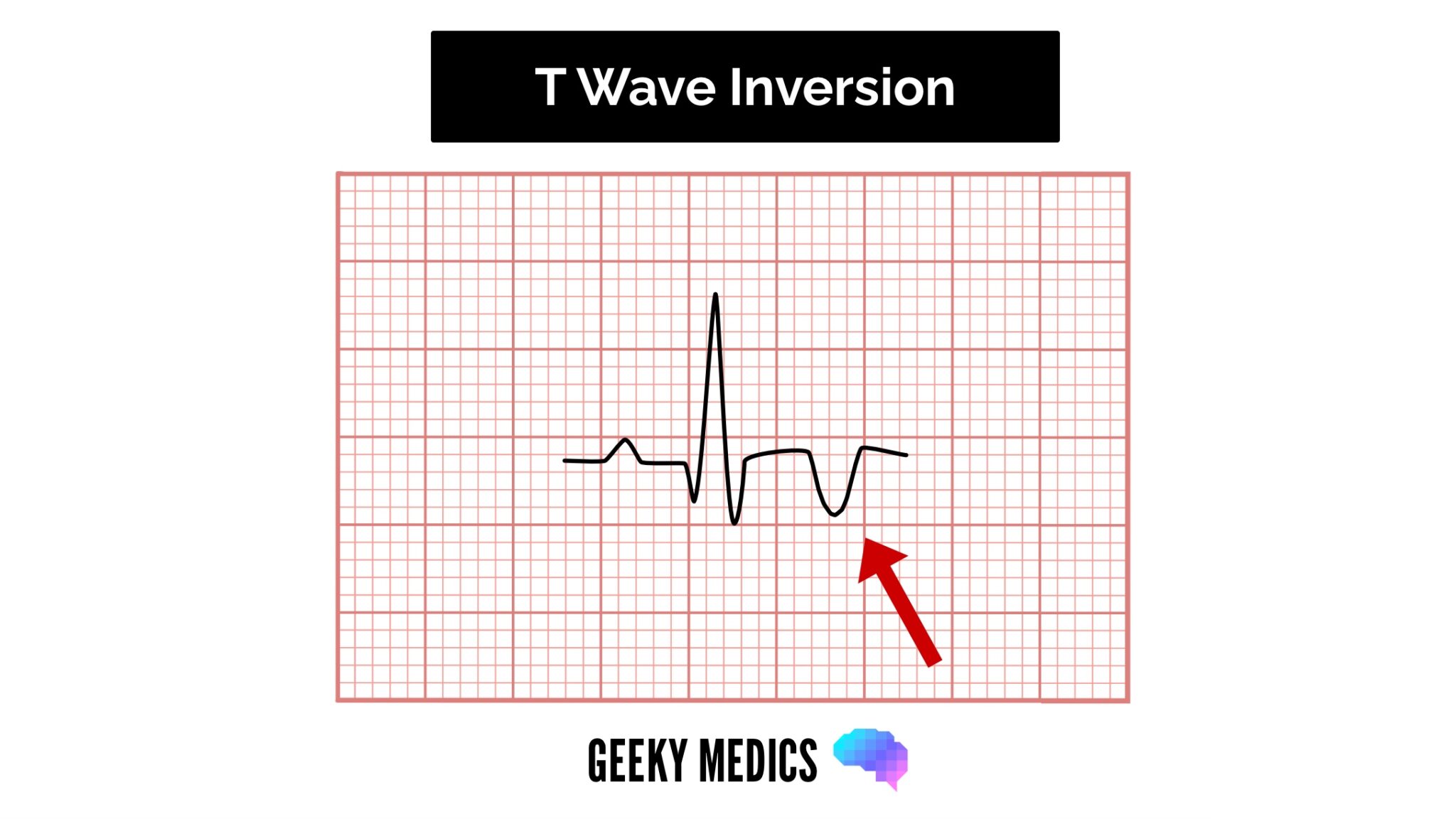 ECG T wave inversion