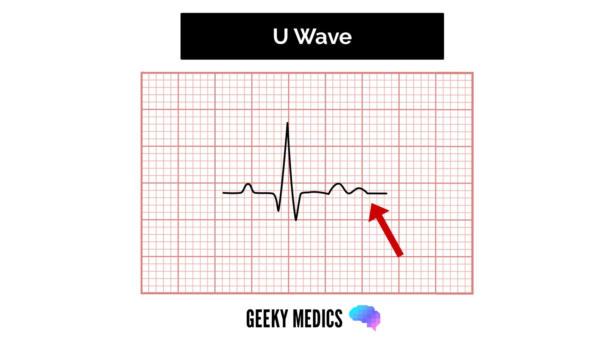 ECG U wave