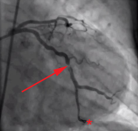 Coronary angiography of a patient with STEMI being treated with primary percoutaneous coronary intervention, showing partial occlusion of left circumflex coronary artery. The guide wire has traversed the occlusion and its tip is visible at the bottom of the image.