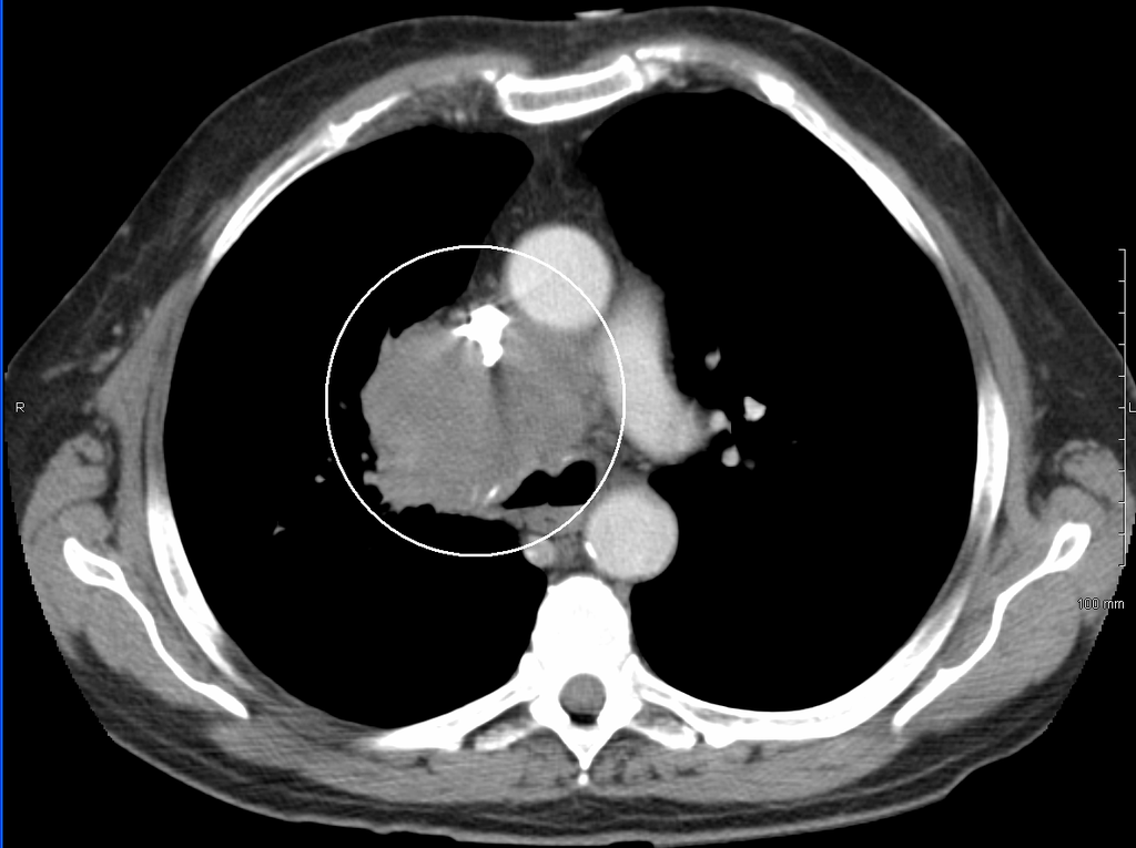 SVC obstruction CT chest