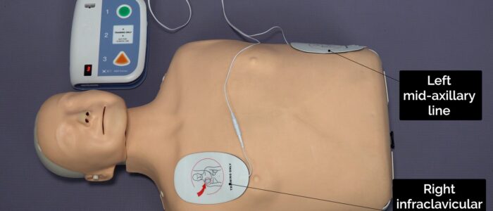 Attach the two self-adhesive pads immediately to the patient’s bare chest