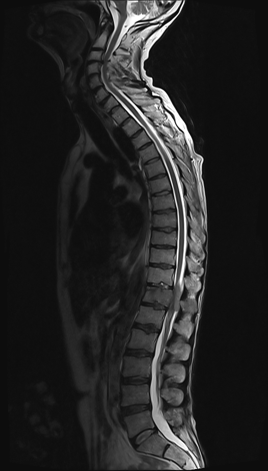 Malignant spinal cord compression on MRI