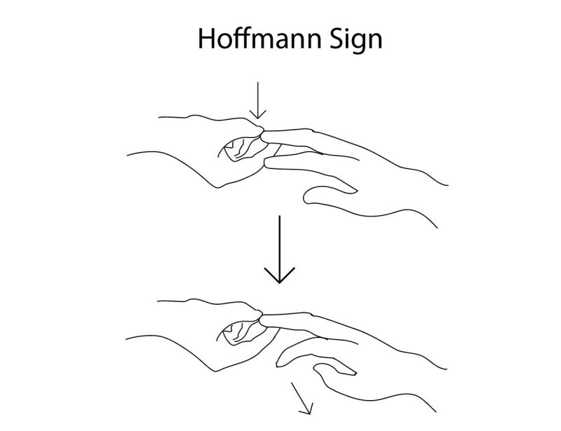 An example of Hoffmann's sign