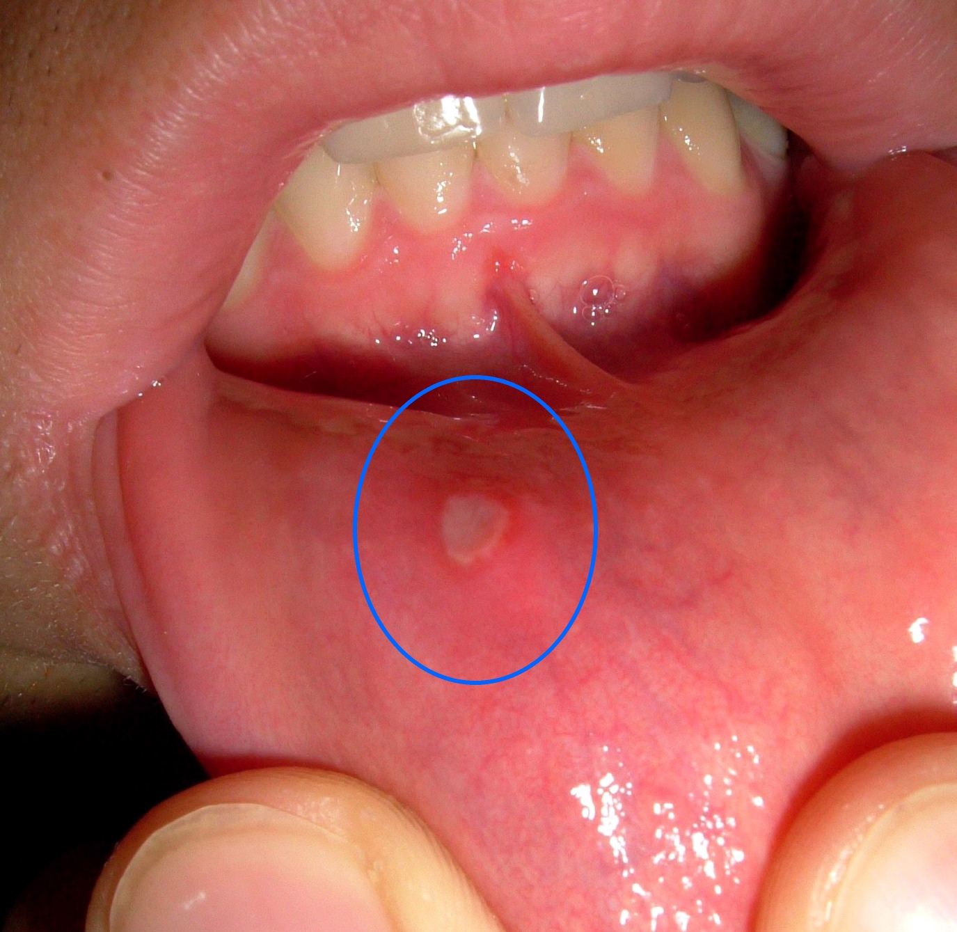 Oral aphthous ulceration