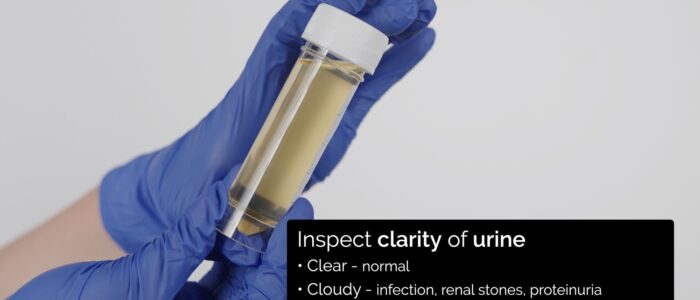 Urinalysis - inspect the clarity of the urine