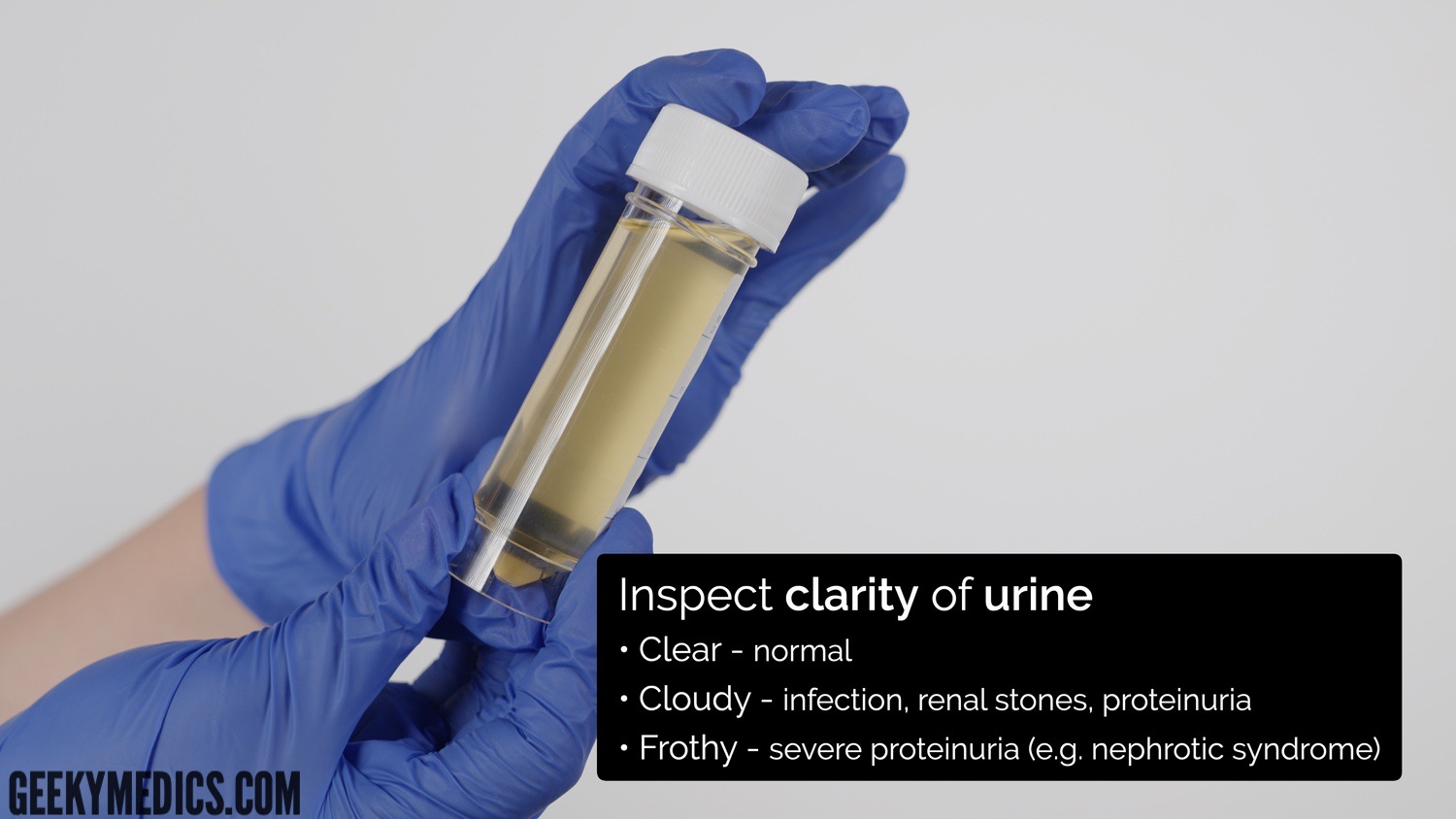 Urinalysis - inspect the clarity of the urine