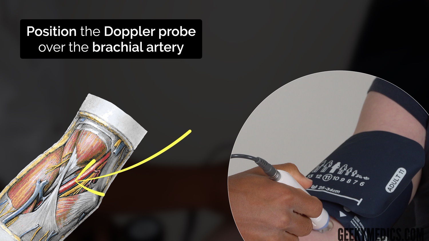 Place the sphygmomanometer cuff over the arm proximal to the brachial artery and position the Doppler probe on the brachial artery at a 45° angle (medial to the biceps tendon in the antecubital fossa)