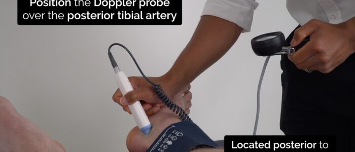 Position the Doppler probe over the posterior tibial artery, which is located posterior to the medial malleolus.