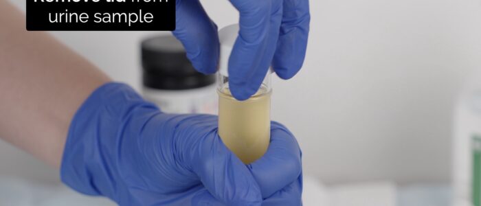 Urinalysis - remove lid from urine sample container