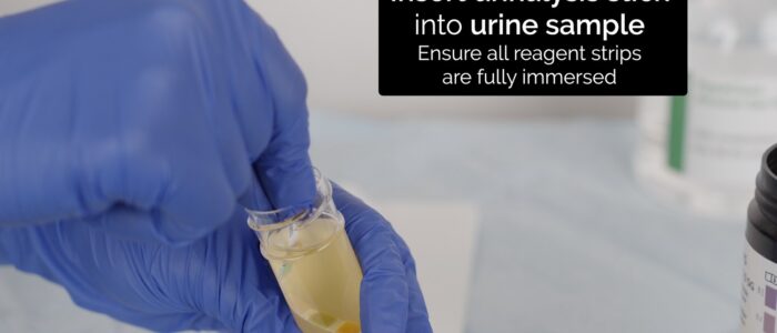 Urinalysis - Insert urinalysis stick into urine sample