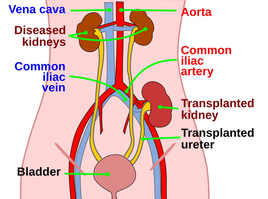 Kidney transplant operation diagram