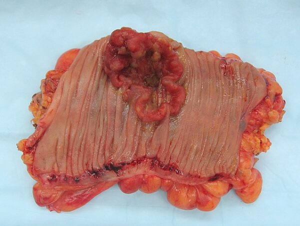 Colorectal cancer resected