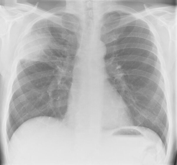 Chest X-ray showing a right sided area of consolidation, representing a segmental pneumonia