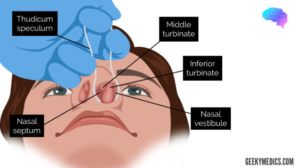 Thudicum speculum insertion - nasal turbinates - nasal septum
