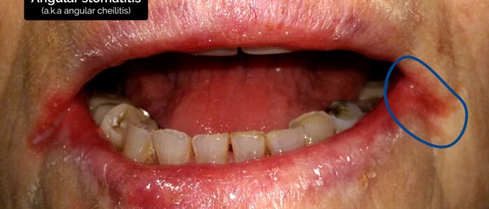 Oral cavity exam - angular stomatitis