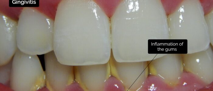 Oral cavity exam - Gingivitis