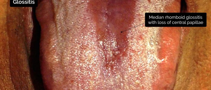 Oral cavity exam - Median rhomboid glossitis with loss of central papillae.9