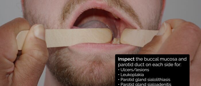 Oral cavity inspection - inspect the buccal mucosa