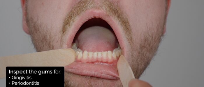 Oral cavity inspection - inspect the gums