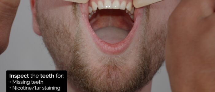 Oral cavity inspection - inspect the teeth