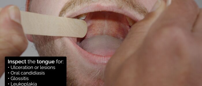 Oral cavity inspection - inspect the tongue