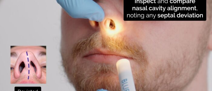 Nasal exam - nostril inspection for nasal cavity alignment