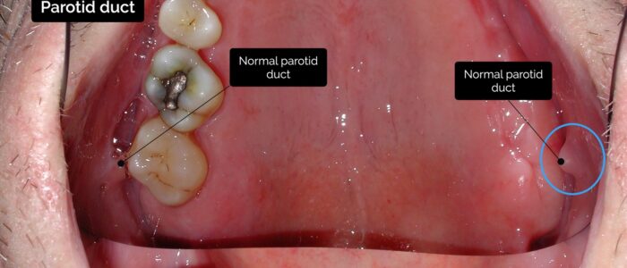 Oral cavity exam - Parotid duct (Stenson's duct)