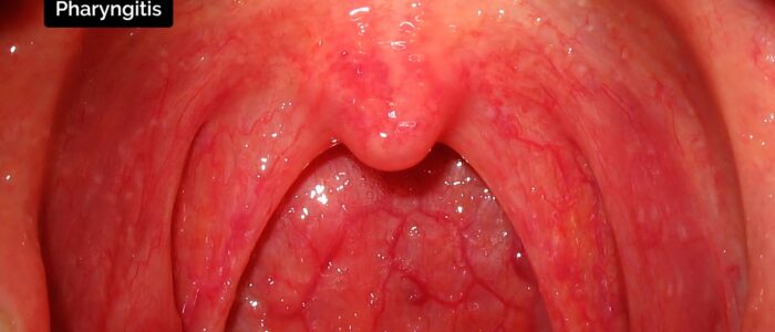 Oral cavity exam - Pharyngitis