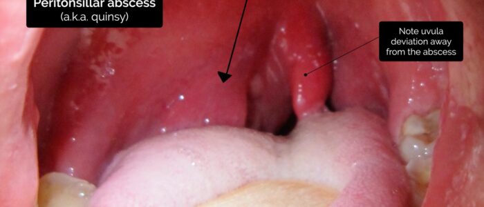 Oral cavity exam - Peritonsillar abscess (quinsy)